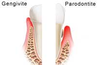 differenze-parodontite-gengivite